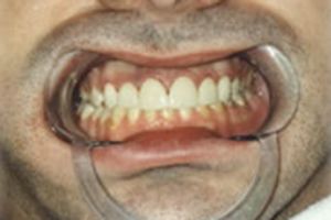 White healthy front teeth