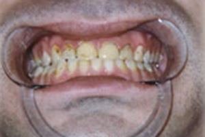 Severely discolored front teeth