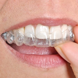 teeth Invisalign