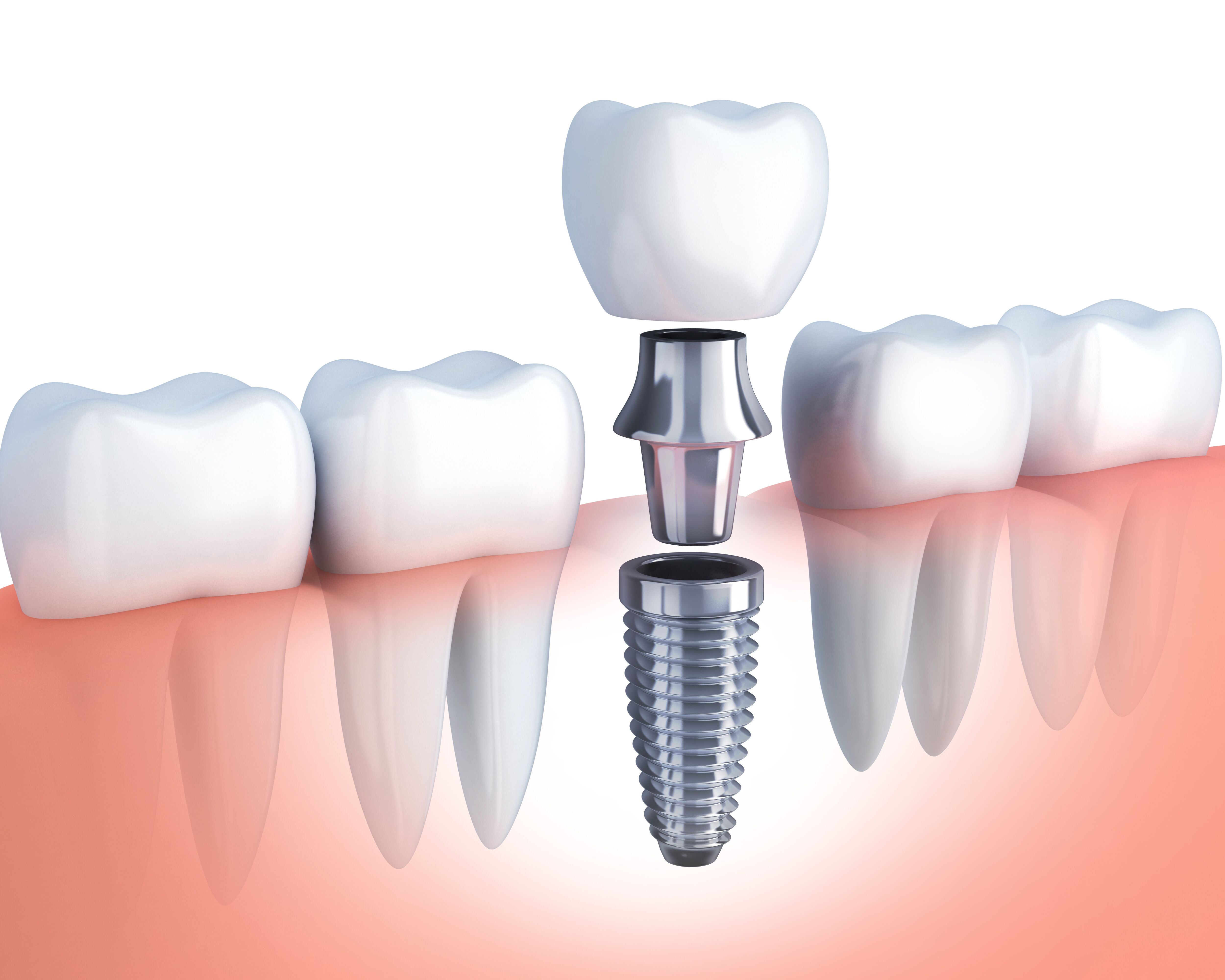 Average Cost of Dental Implants Columbia MD - Tooth Implant